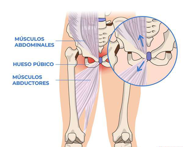 پوبالژیا بیماری فوتبالیست ها