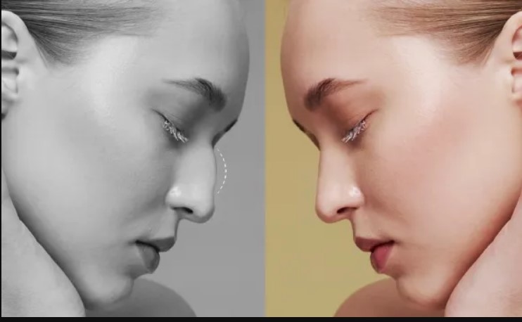 جراحی غوز بینی ۲۰۲۶